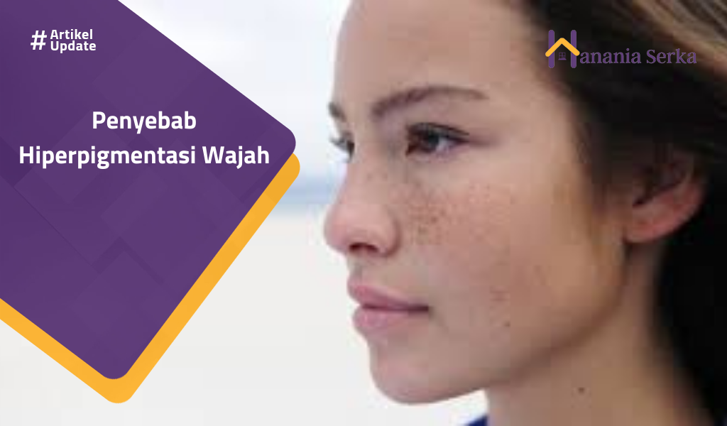 You are currently viewing Penyebab Hiperpigmentasi Wajah