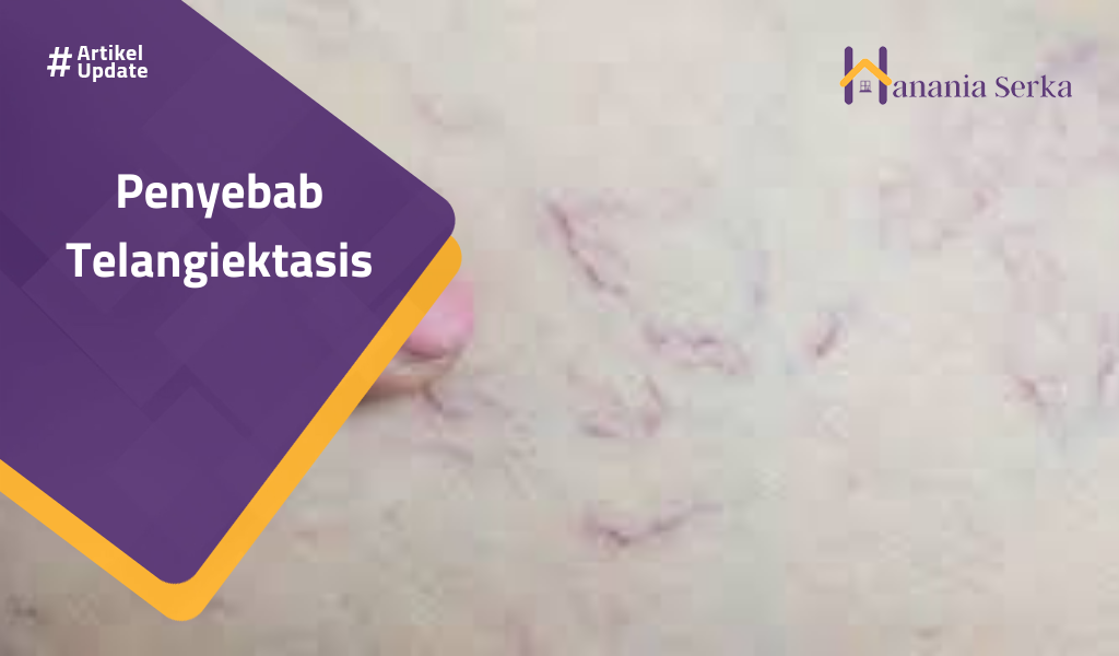 You are currently viewing Penyebab Telangiektasis