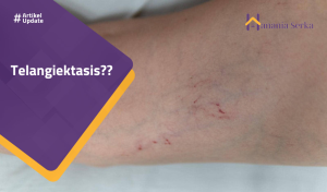 Read more about the article Telangiektasis??