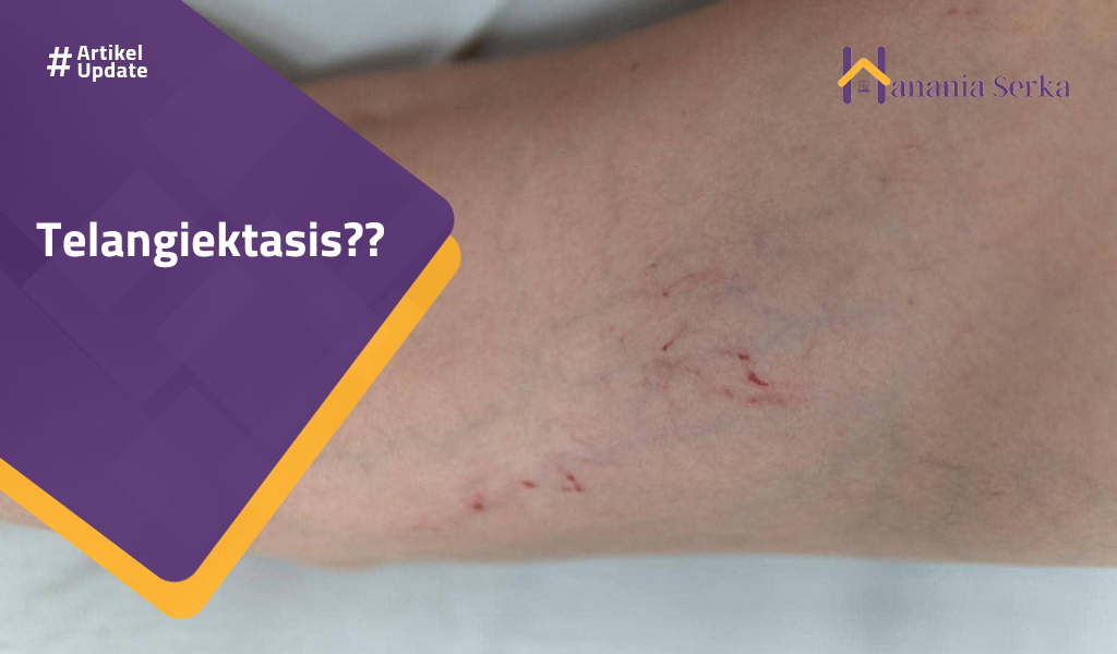 You are currently viewing Telangiektasis??