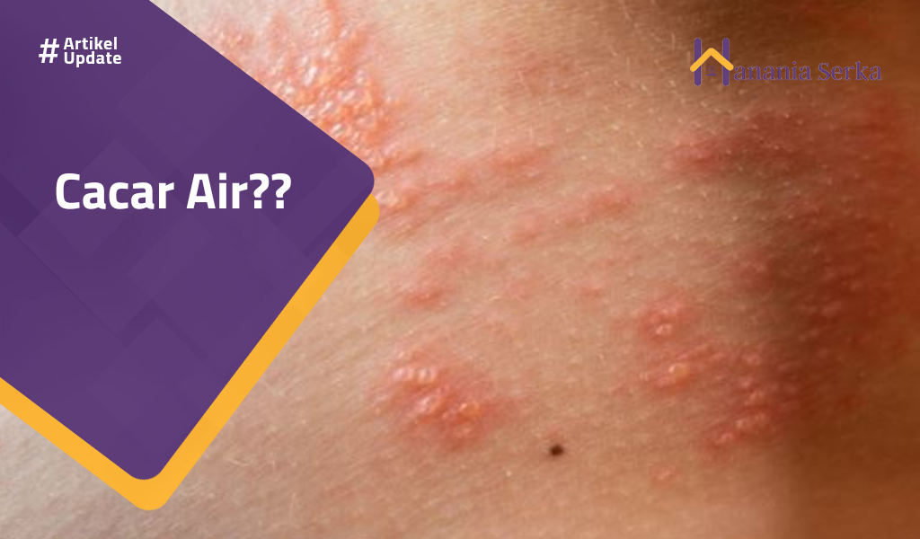 You are currently viewing Cacar Air?