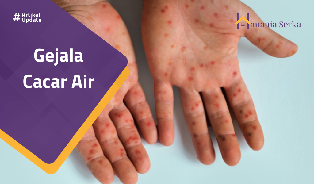 Read more about the article Gejala Cacar Air