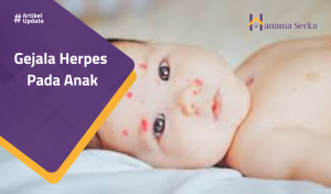 Read more about the article Gejala Herpes Pada Anak