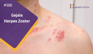 Read more about the article Gejala Herpes Zoster