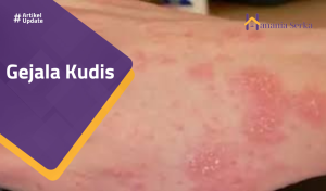 Read more about the article Gejala Kudis