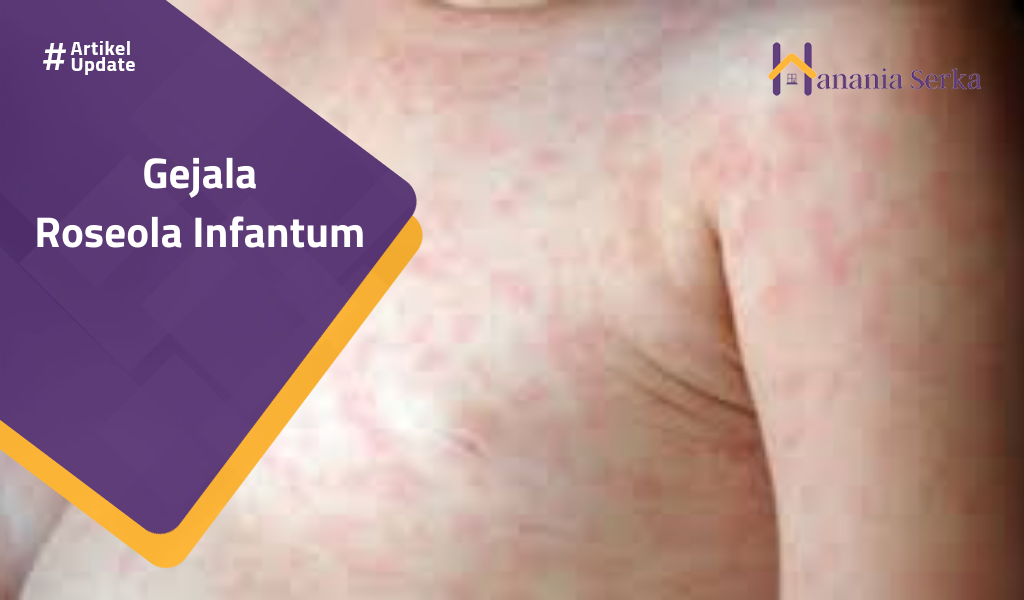 You are currently viewing Gejala Roseola Infantum
