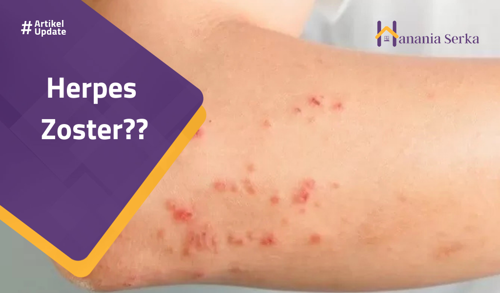 Read more about the article Herpes Zoster?