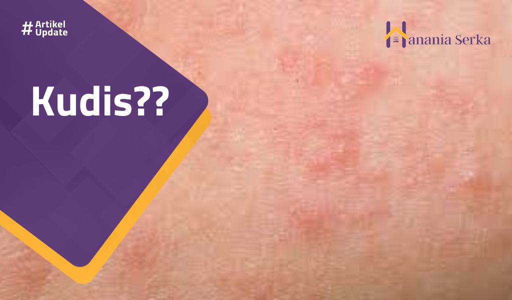 Read more about the article Kudis??