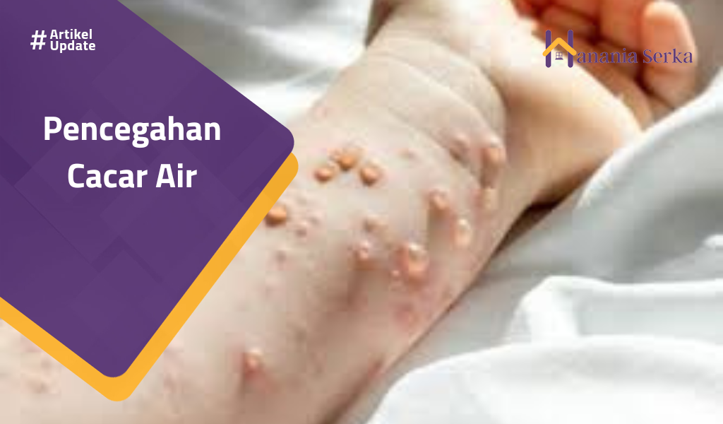 Read more about the article Pencegahan Cacar Air
