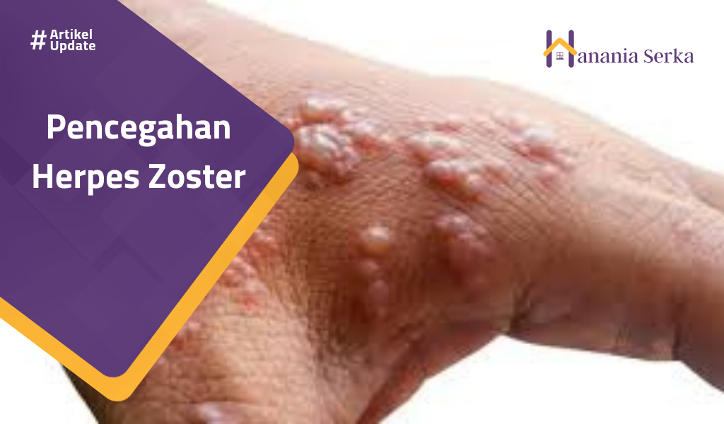 You are currently viewing Pencegahan Herpes Zoster