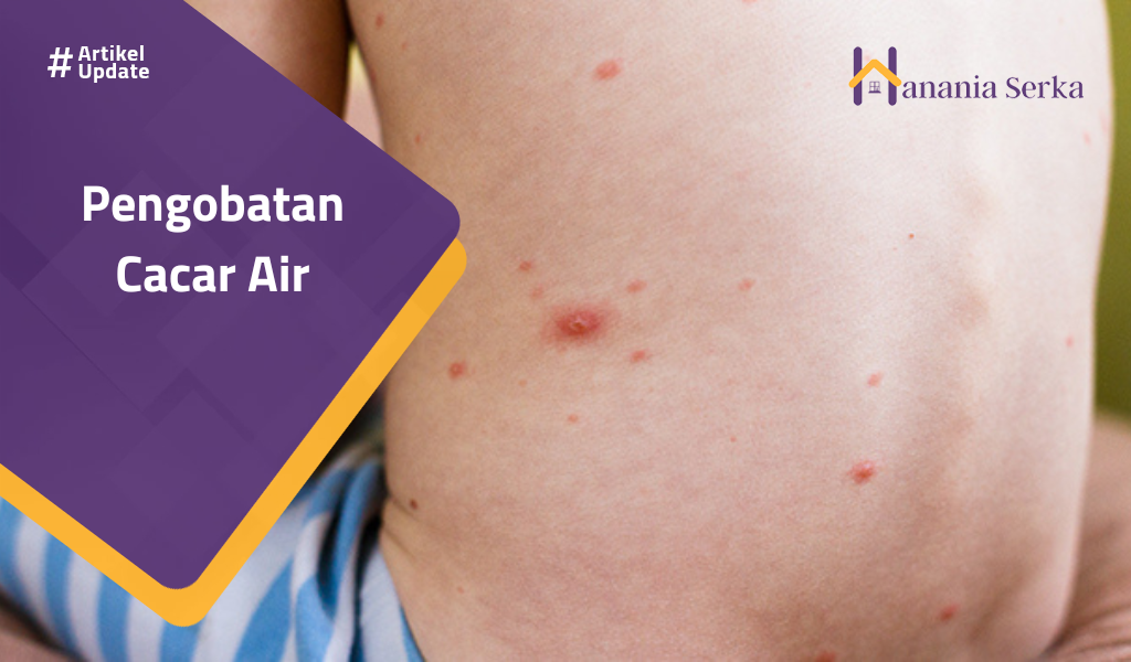You are currently viewing Pengobatan Cacar Air