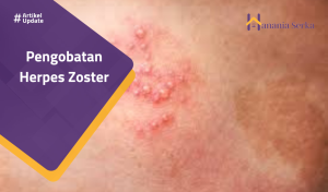 Read more about the article Pengobatan Herpes Zoster