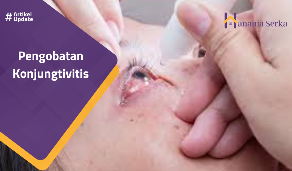 Read more about the article Pengobatan Konjungtivitis