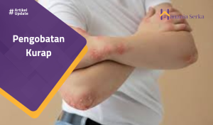 Read more about the article Pengobatan Kurap