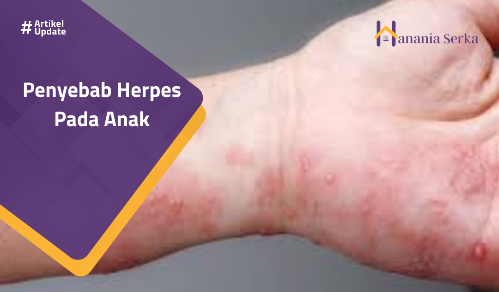 You are currently viewing Penyebab Herpes Pada Anak