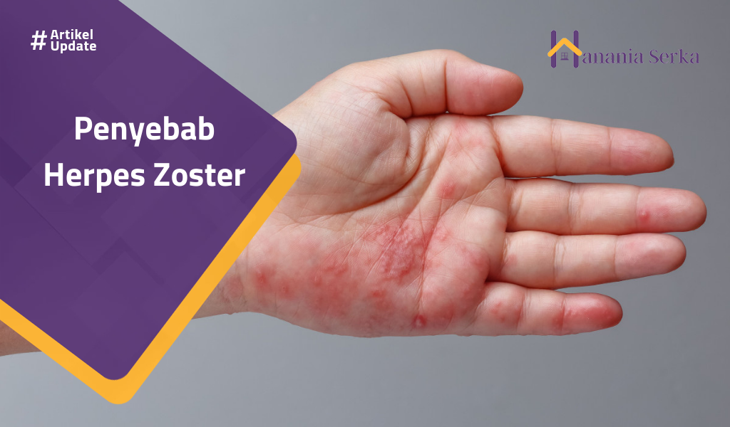 You are currently viewing Penyebab Herpes Zoster