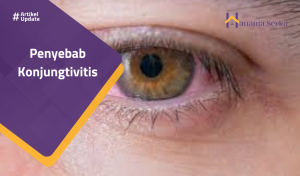 Read more about the article Penyebab Konjungtivitis