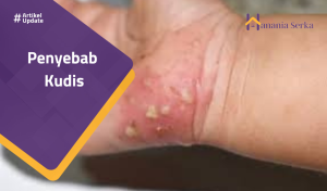 Read more about the article Penyebab Kudis