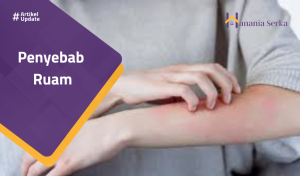 Read more about the article Penyebab Ruam