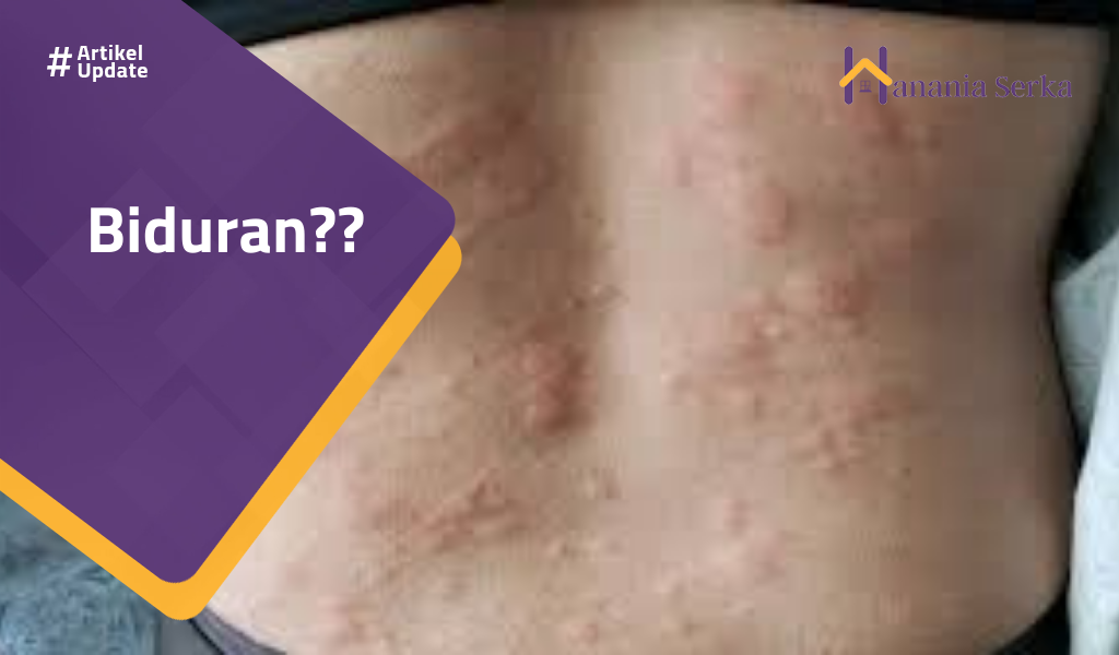 You are currently viewing Biduran??