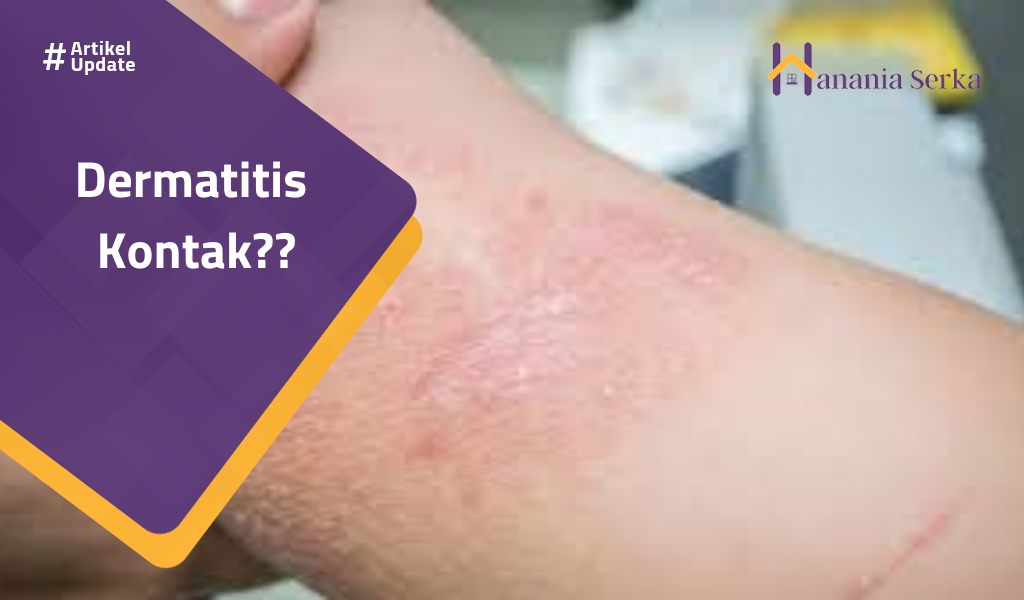Read more about the article Dermatitis Kontak??