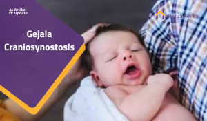 Read more about the article Gejala Craniosynostasis