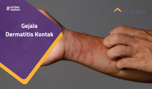 Read more about the article Gejala Dermatitis Kontak
