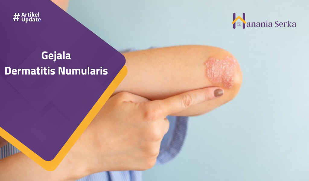You are currently viewing Gejala Dermatitis Numularis