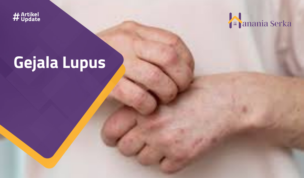Read more about the article Gejala Lupus