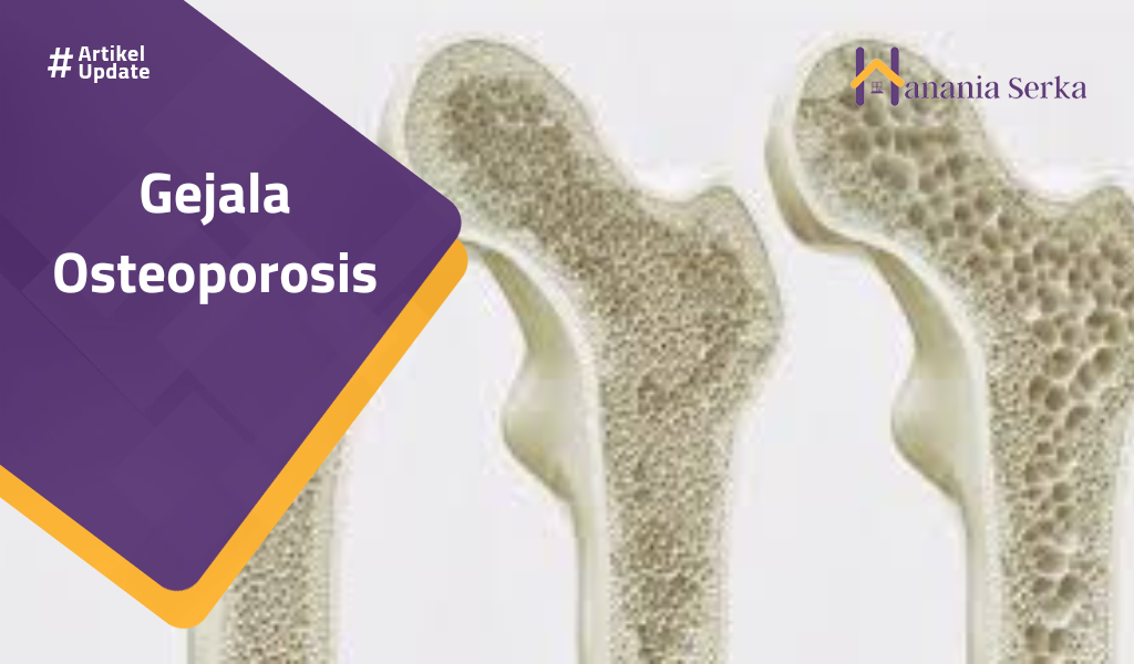 Read more about the article Gejala Osteoporosis