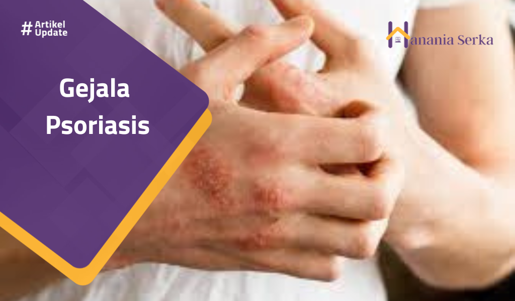 You are currently viewing Gejala Psoriasis