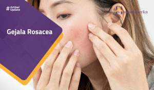 Read more about the article Gejala Rosacea