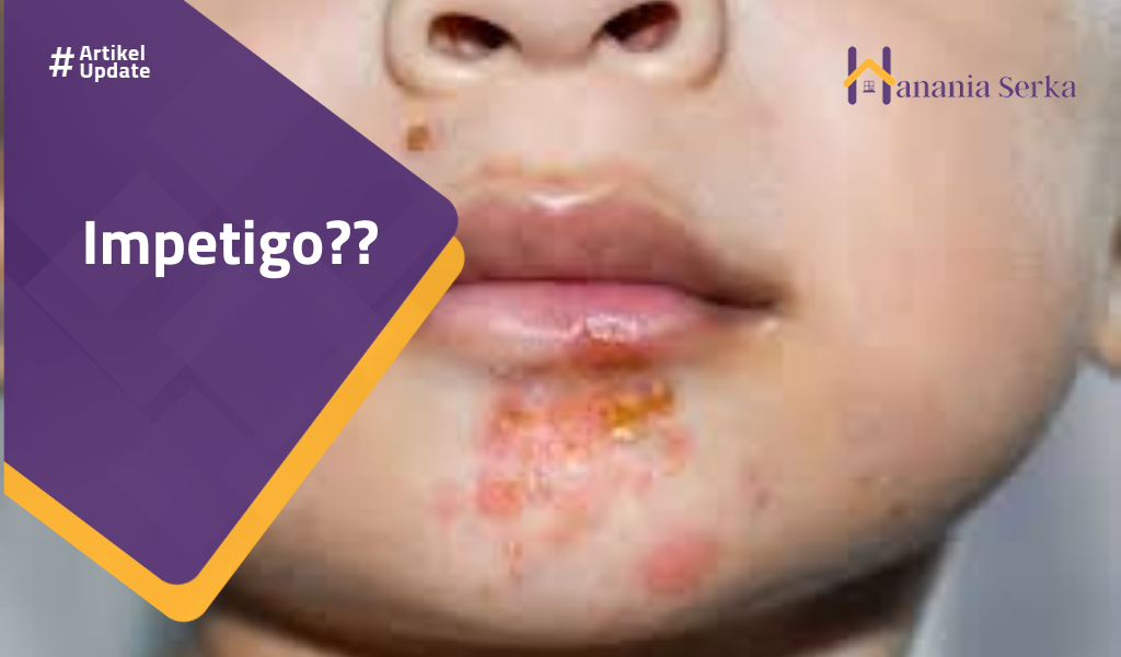 Read more about the article Impetigo??