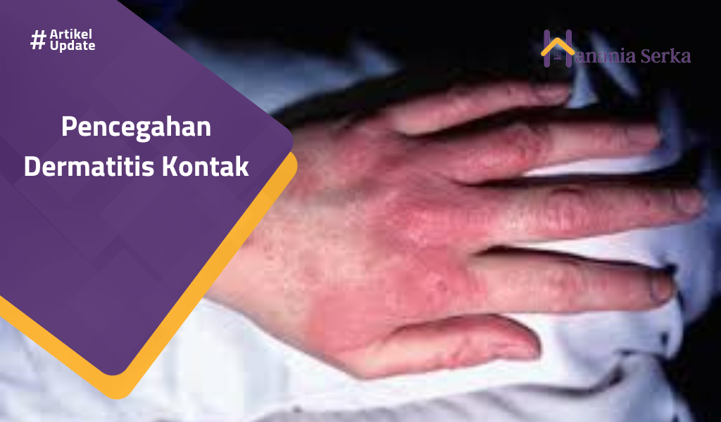 Read more about the article Pencegahan Dermatitis Kontak