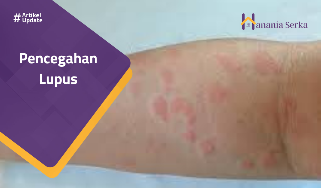 You are currently viewing Pencegahan Lupus