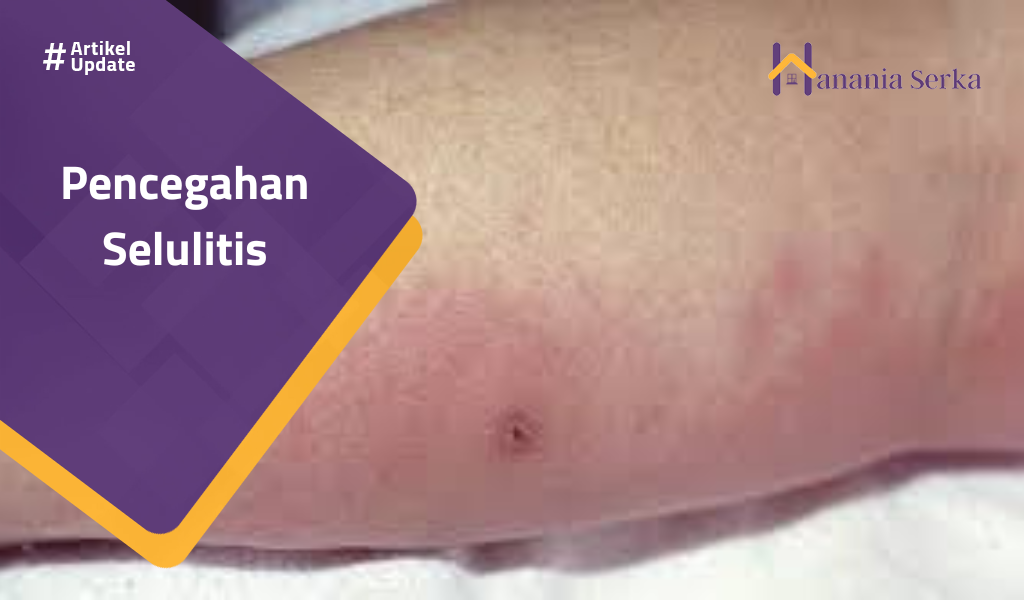Read more about the article Pencegahan Selulitis