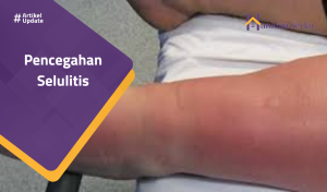 Read more about the article Pencegahan Selulitis