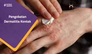 Read more about the article Pengobatan Dermatitis Kontak