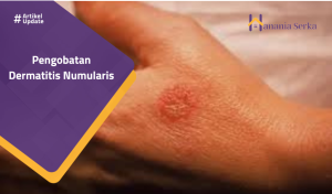 Read more about the article Pengobatan Dermatitis Numularis