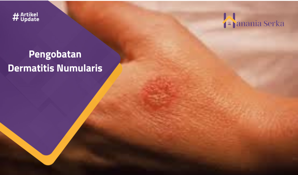 Read more about the article Pengobatan Dermatitis Numularis