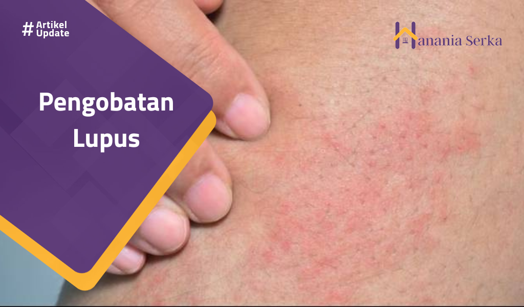 Read more about the article Pengobatan Lupus