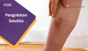 Read more about the article Pengobatan Selulitis