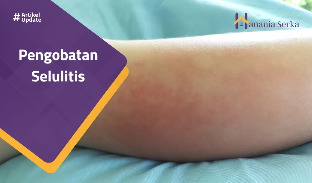 Read more about the article Pengobatan Selulitis