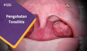 Read more about the article Pengobatan Tonsilitis