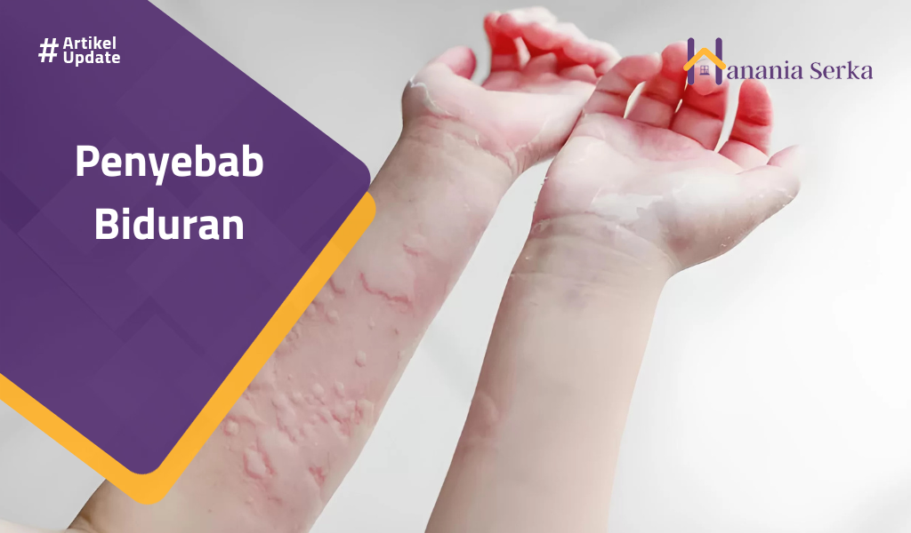 You are currently viewing Penyebab Biduran