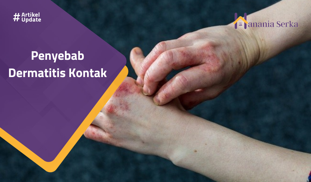 Read more about the article Penyebab Dermatitis Kontak