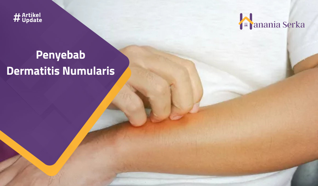 You are currently viewing Penyebab Dermatitis Numularis