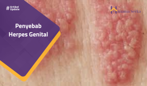 Read more about the article Penyebab Herpes Genital