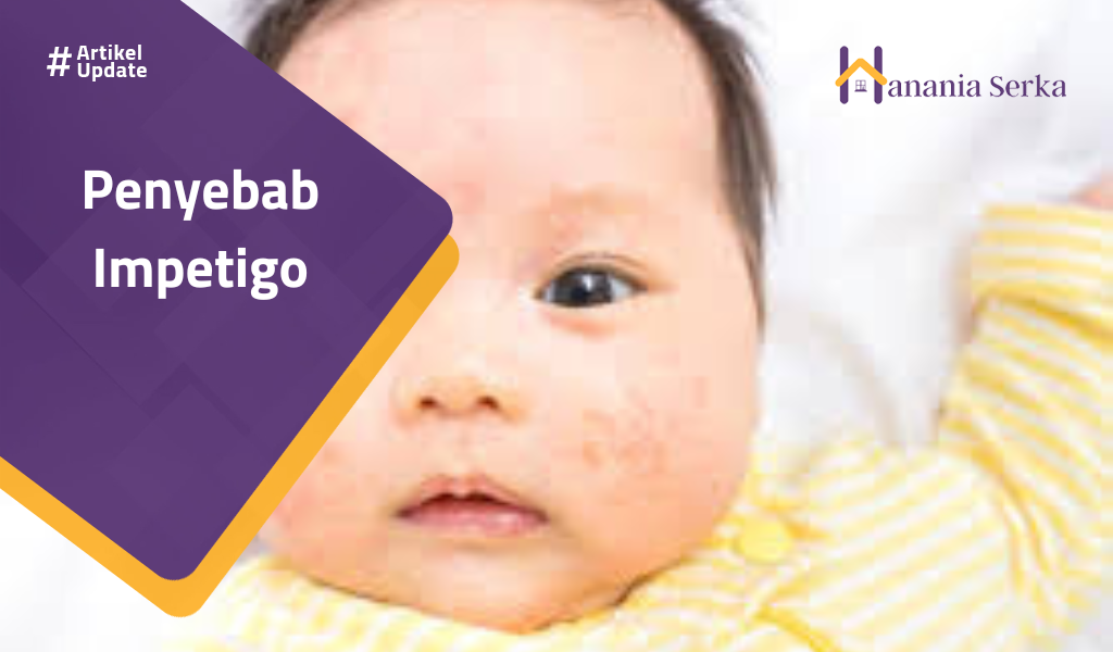 You are currently viewing Penyebab Impetigo