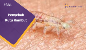 Read more about the article Penyebab Kutu Rambut